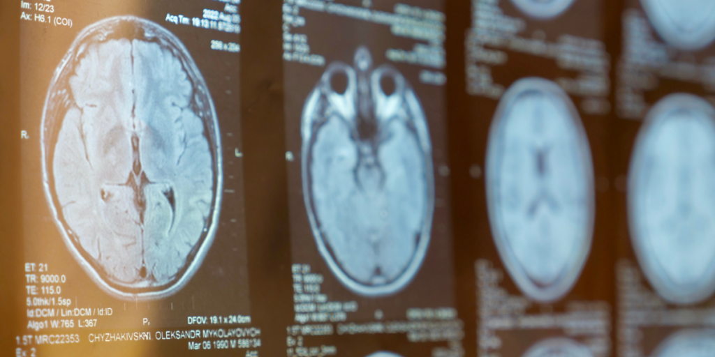 Brain, scan, MRI