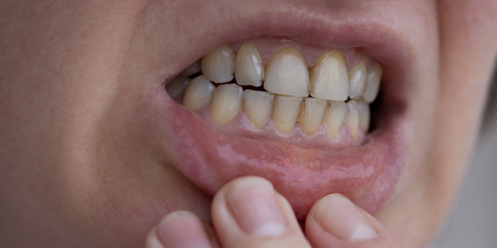 Teeth, tænder