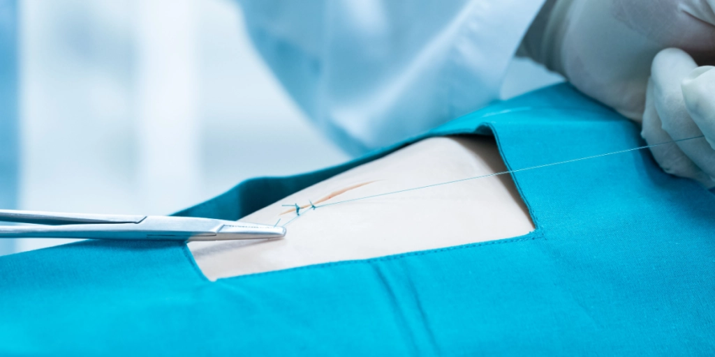 Suture, doctor, healthcare, surgery