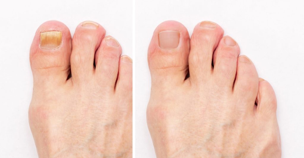 Gesunde und schöne Nägel für den Sommer – Schluss mit gelbem Nagelpilz an den Zehen