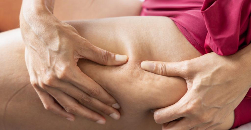 cellulite,appelsinhud