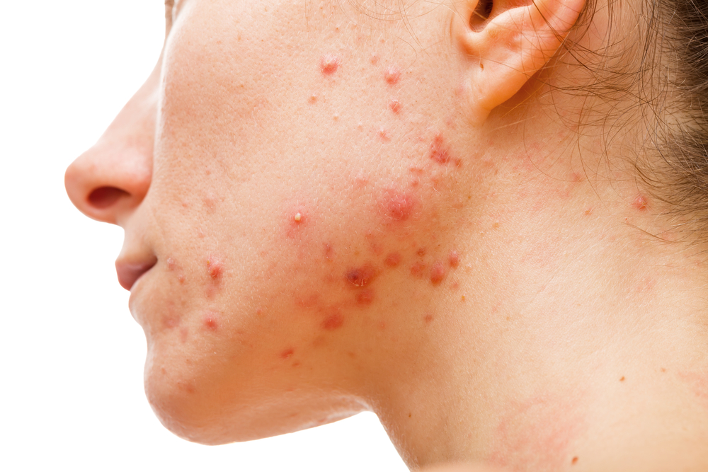 Acne,Skin,akne,hud