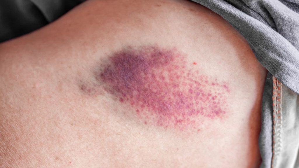 Bruise