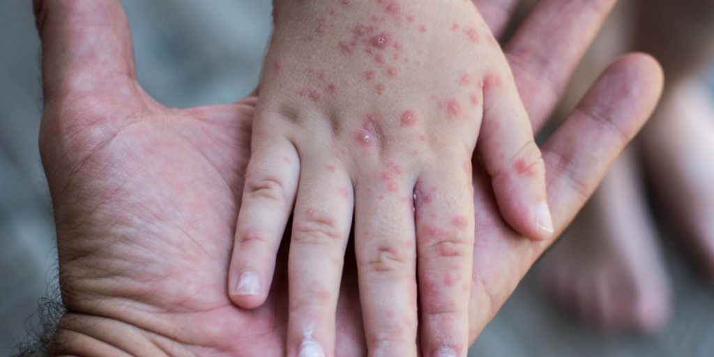 Coxsackie virus