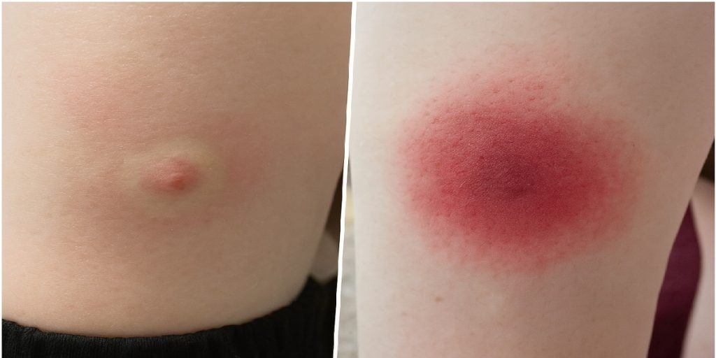 Flåtbid infektion