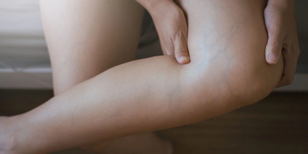Er dine ben klar til sommeren? Det her bør du vide om åreknuder