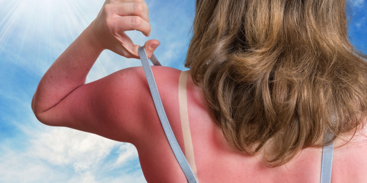 Solbrædt, solskoldning, sunburn