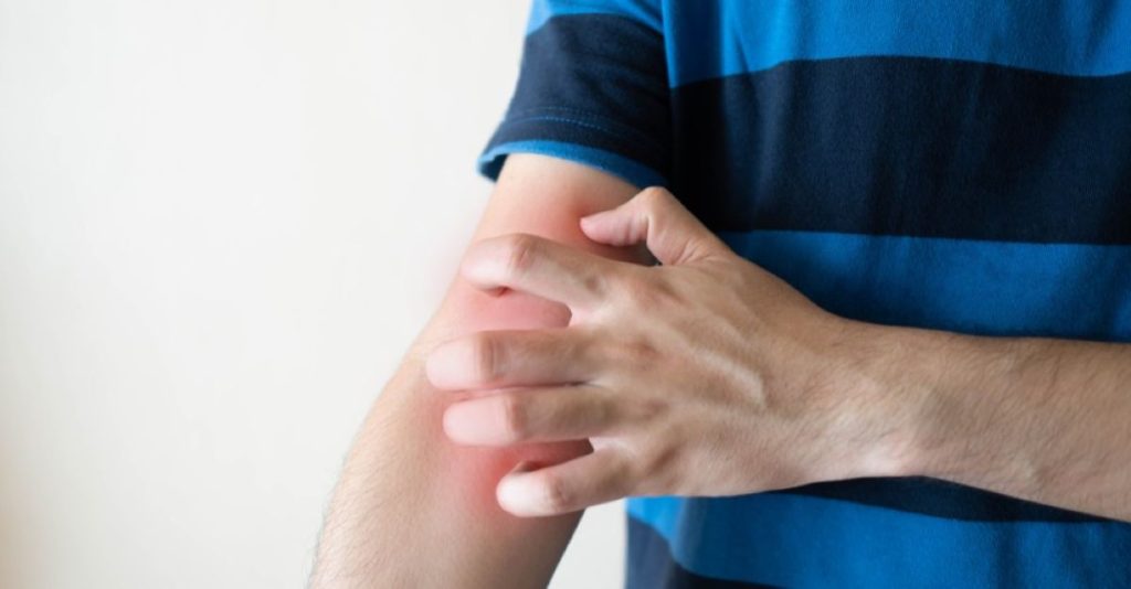 psoriasis skin itch scratch