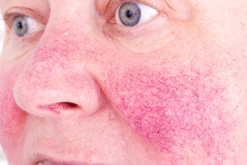 blood,vessels,blodkar