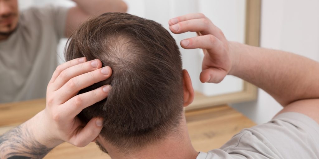 Hårtab, Hair Loss