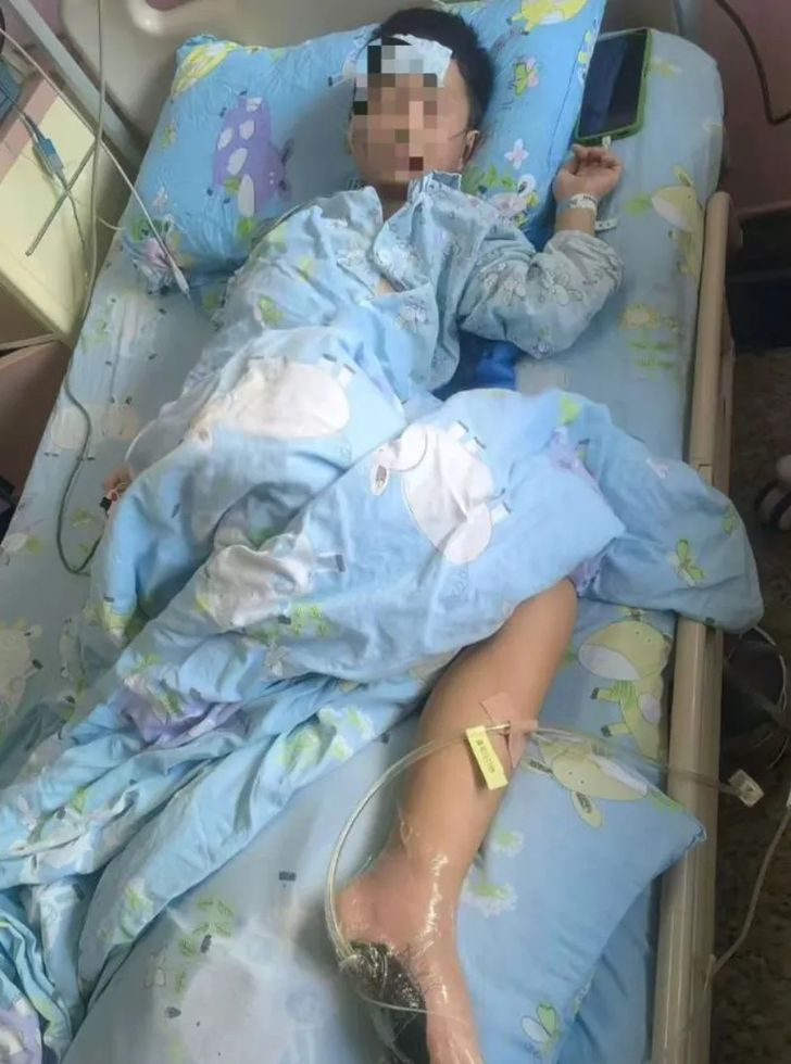6-årigt barn var tæt på at dø efter at have trådt på en død fisk