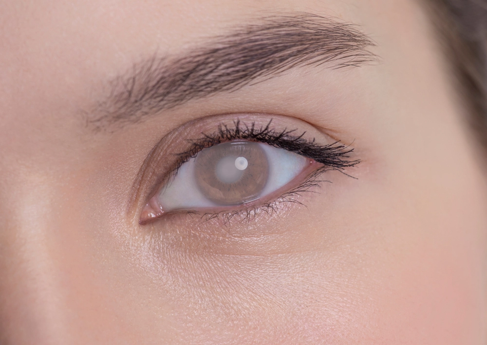 Eye of a woman with cataract and corneal opacity, slørede øjne