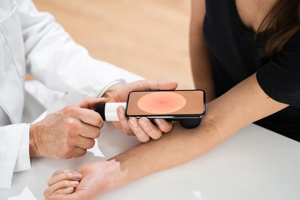føflekk, mole, hud, skin, helse, health