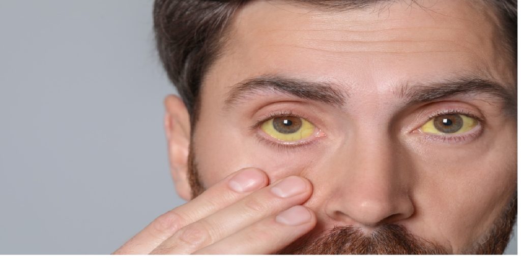 yellow eyes sick cancer man