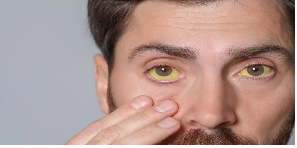 yellow eyes sick cancer man