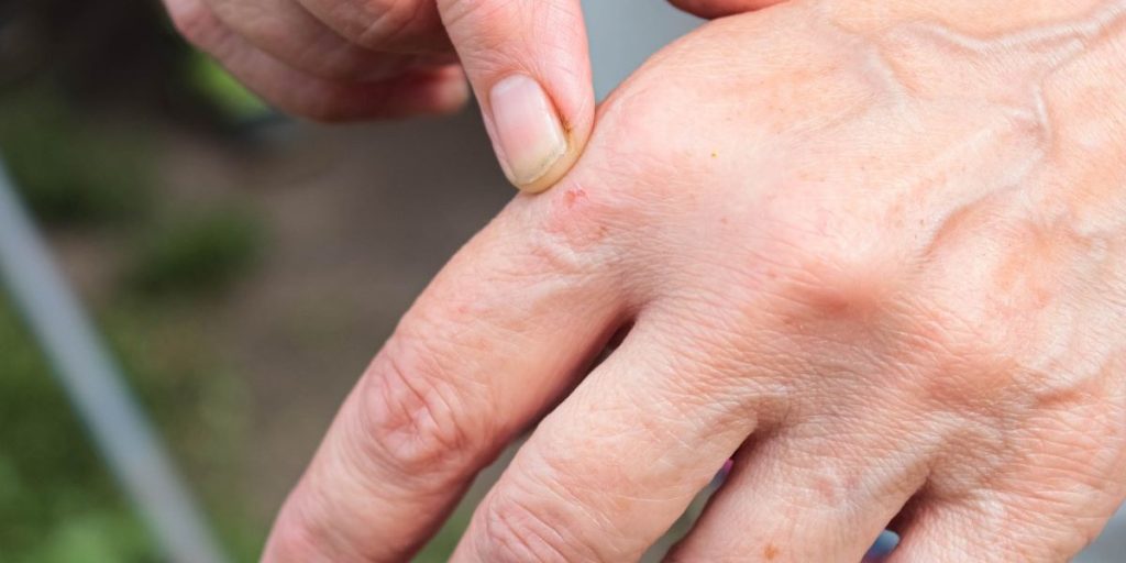 Kæmper du med tørre vinterhænder? Dette er hudlægens råd