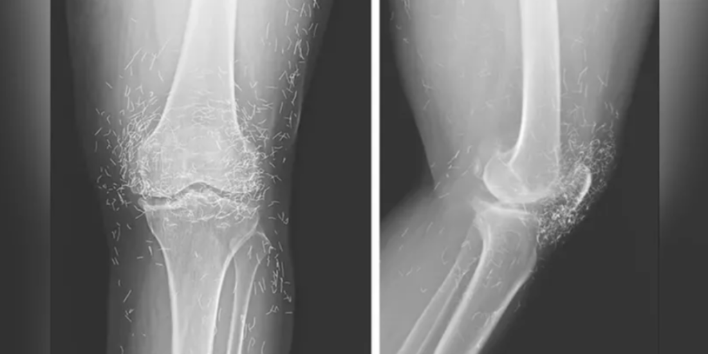 Knæ. knee, x ray