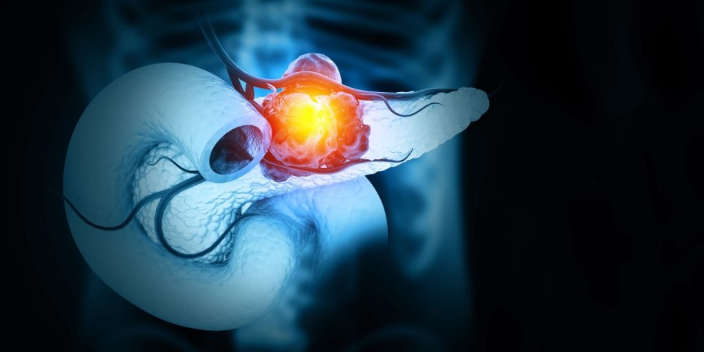 Cancer, pancreas, kræft, bugspytkirtel