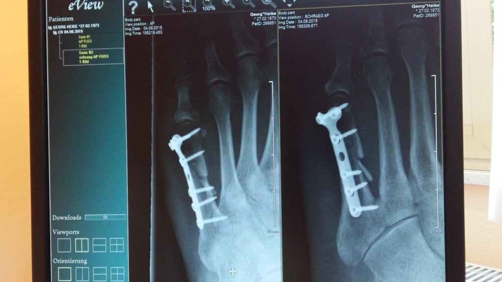 roentgen x-ray fracture