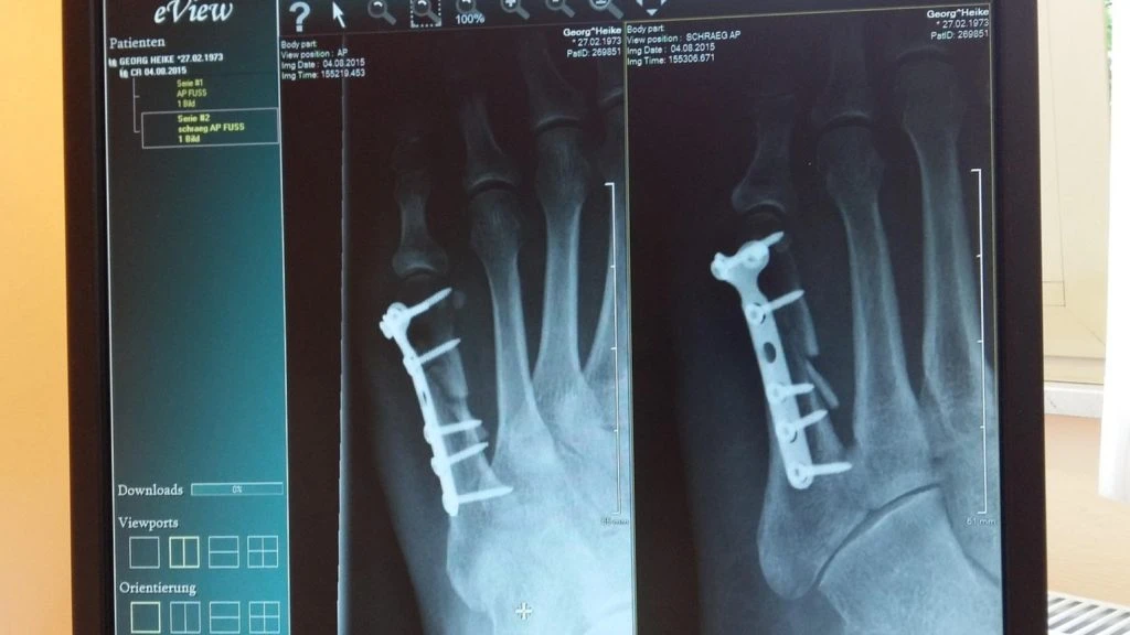 roentgen x-ray fracture