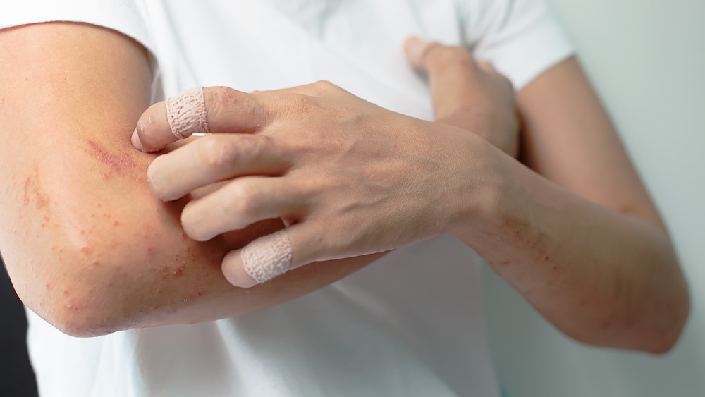 man rash