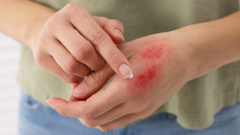 hand burn