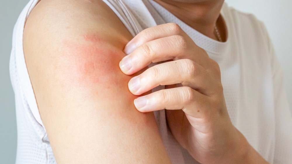 itching and scratching on arm from allergic itchy dry skin eczema dermatitis insect bites