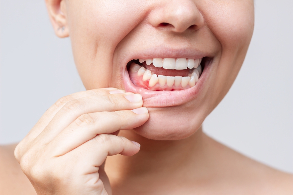 tannkjøtt, gums, tenner, teeth