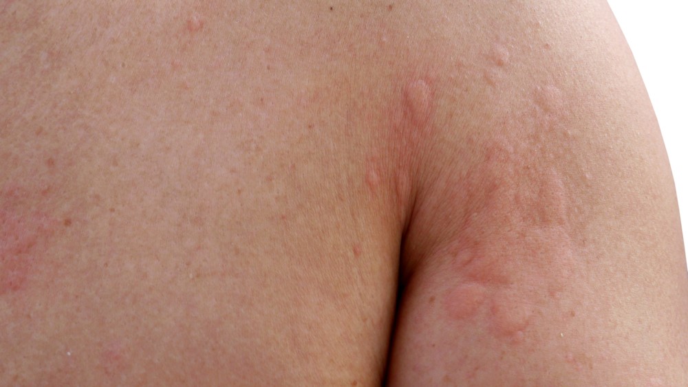 rash