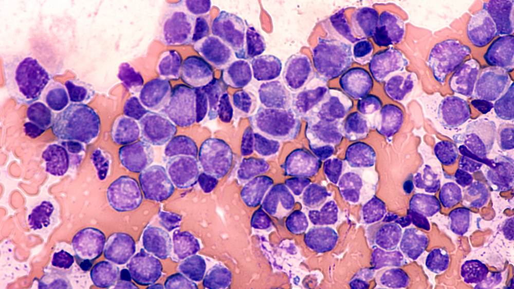 Leukemia, bone marrow, cells, celler, cell death, cancer, kræft