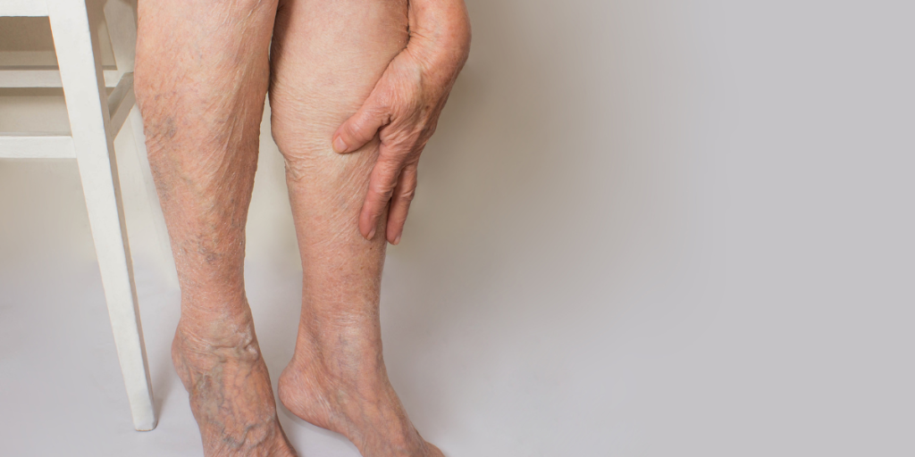 hævelse ben swelling elderly pensionist ældre kvinde