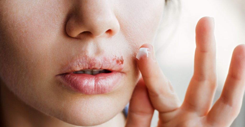 Cold sore, munsår, forkølelsessår