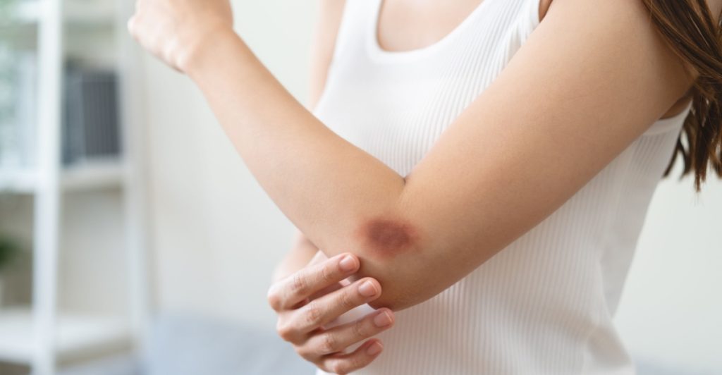 Bruises, sår, blåmärke