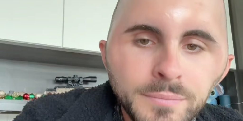 Alex fik hårtransplantation i en alder af 27 år: Endte med at have en chokerende bivirkning