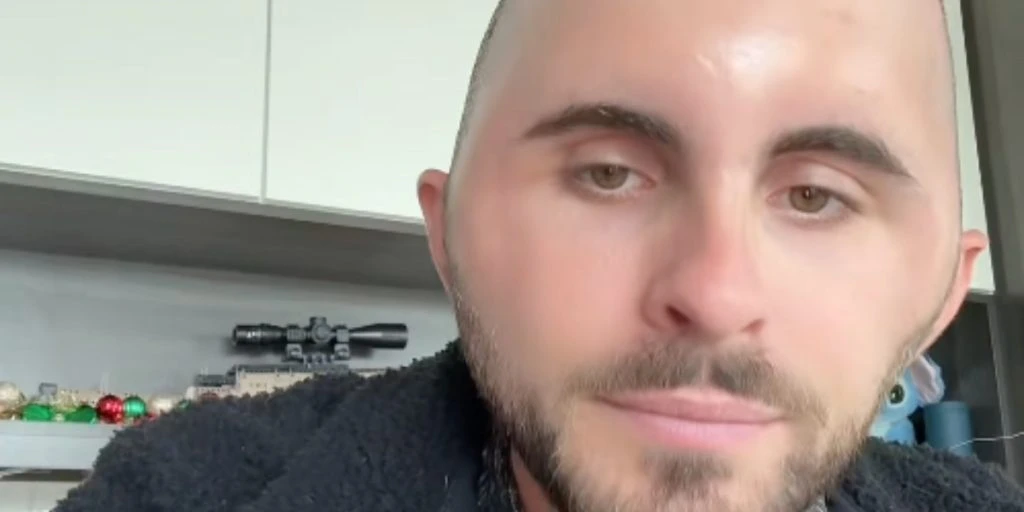 Alex fik hårtransplantation i en alder af 27 år: Endte med at have en chokerende bivirkning