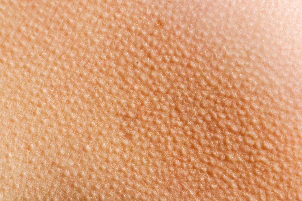 Goose bumps, gåsehud, chills, frysninger
