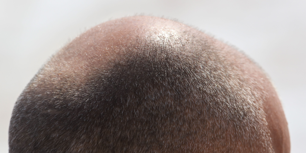Bald, hair transplant