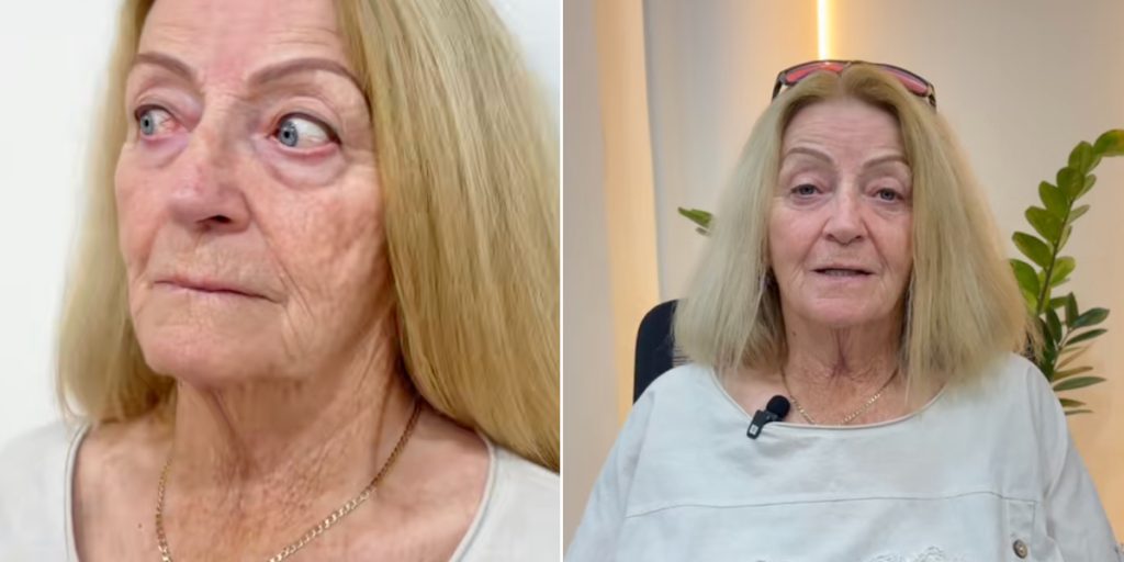 Kvinde fik lavet facelift som 73-årig og blev 20 år yngre: Nu viser hun sin vilde forvandling