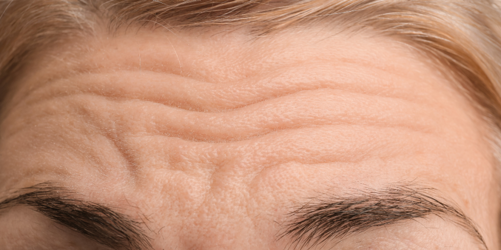 rynke på panden forehead wrinckles