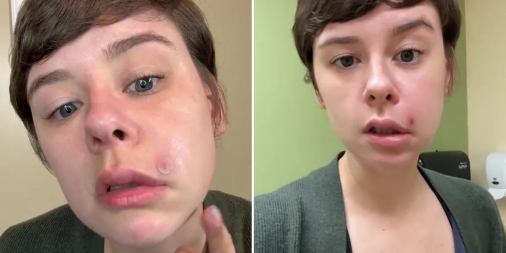 Ung kvinde prikkede en lille bums: Så endte hun på hospitalet med farlig infektion