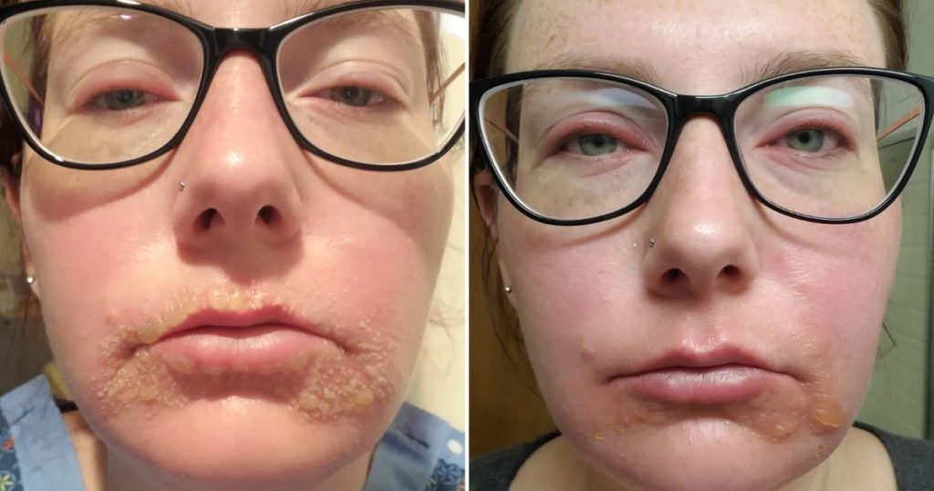 Hun lever som ‘virkelig vampyr’: 30 sekunder i solen kan sende hende på hospitalet