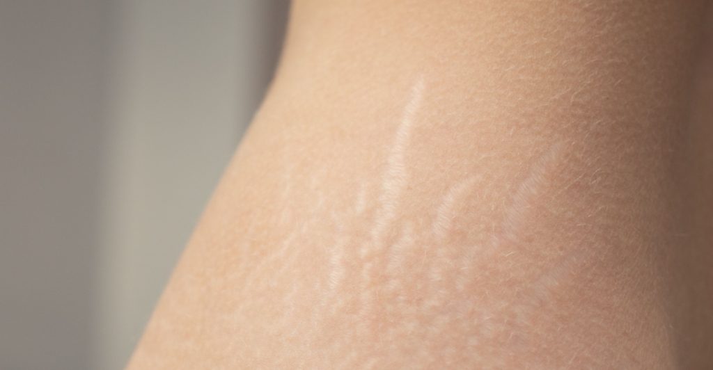 Stretch marks, bristningar, strækmærker