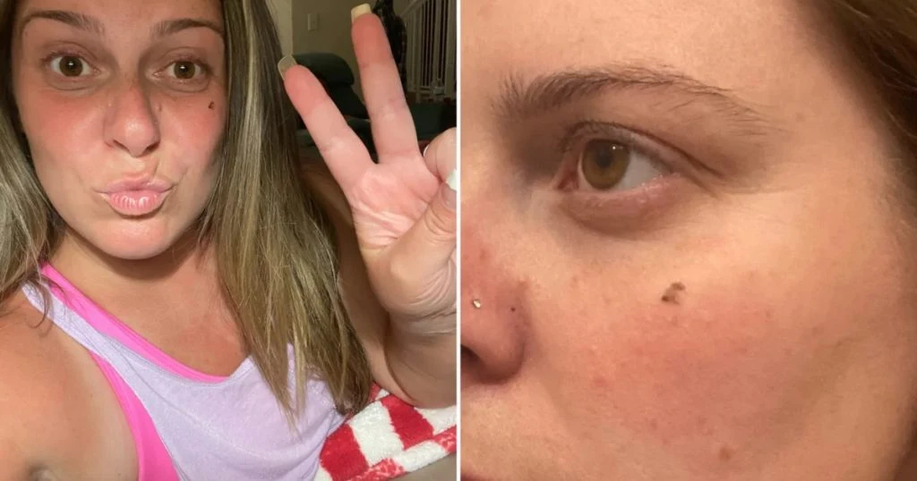 Kvinde opdager mærkeligt mærke i ansigtet: Test afslører chokerende diagnose
