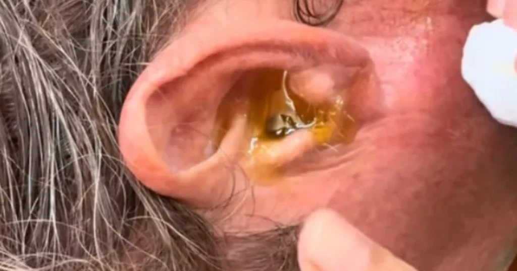 Mand kan høre noget i sit øre: Hans kone er slet ikke forberedt på, hvad der kommer ud