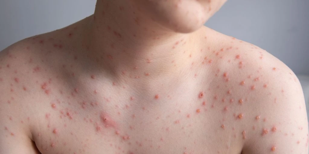 Gratis skoldkoppevaccine kan være på vej – men eksperter advarer om mulige konsekvenser