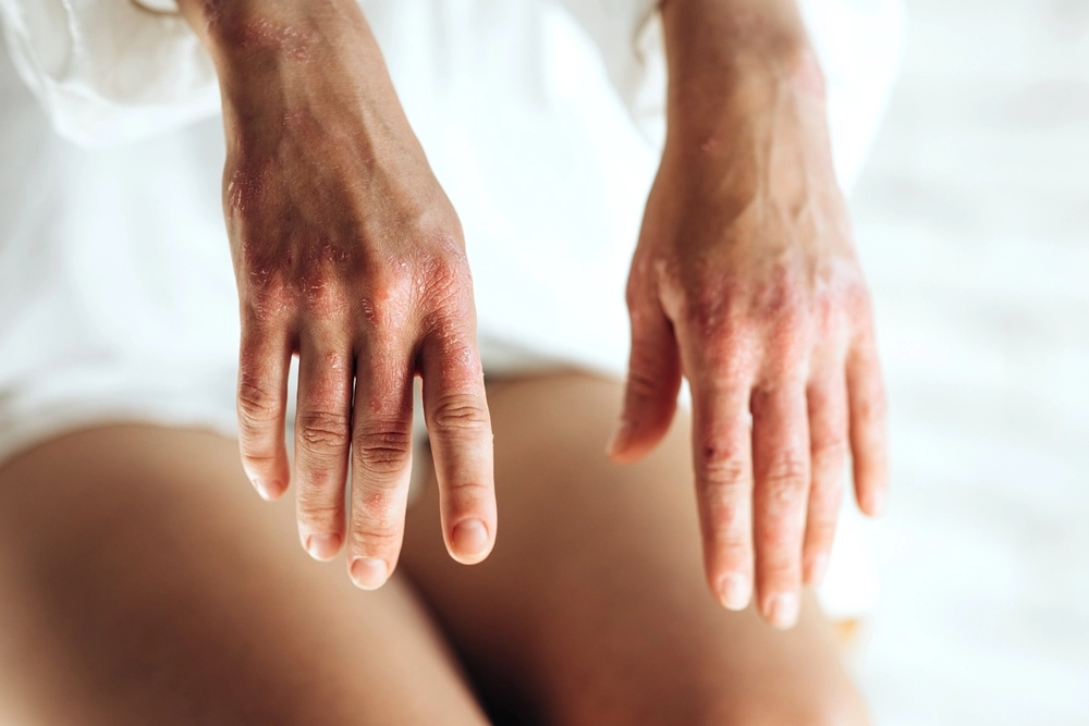 Ekspertens råd mot psoriasis: Enkle grep kan hjelpe