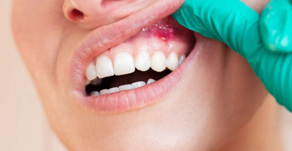 Bleeding gum, tandkød, tandkött