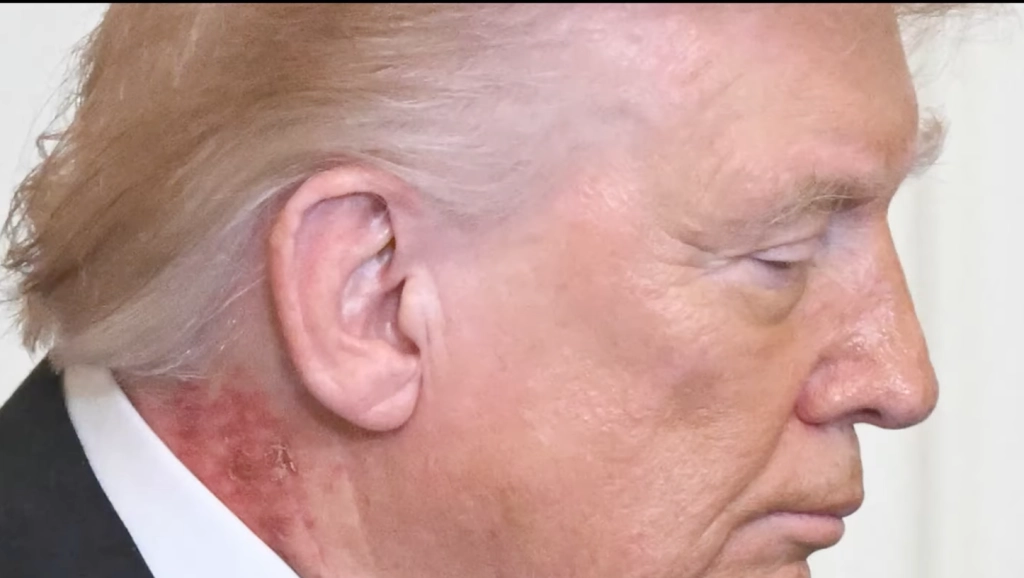 Scabbing rash spotted on Trump’s neck at White House event