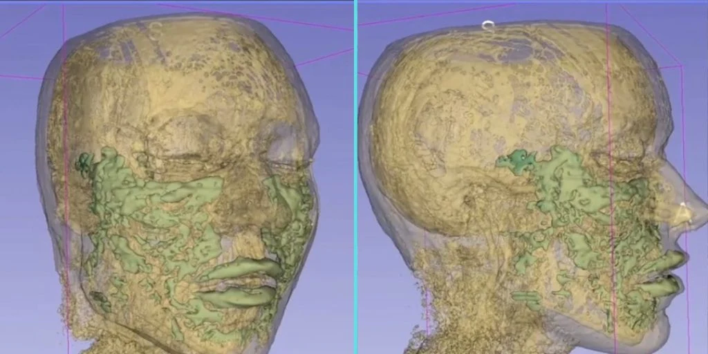 MRI scanning face filler