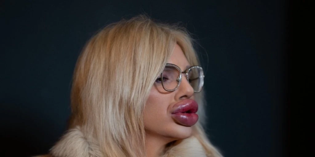 Hun har de ‘største læber i verden’: Du gætter aldrig, hvad de har kostet hende